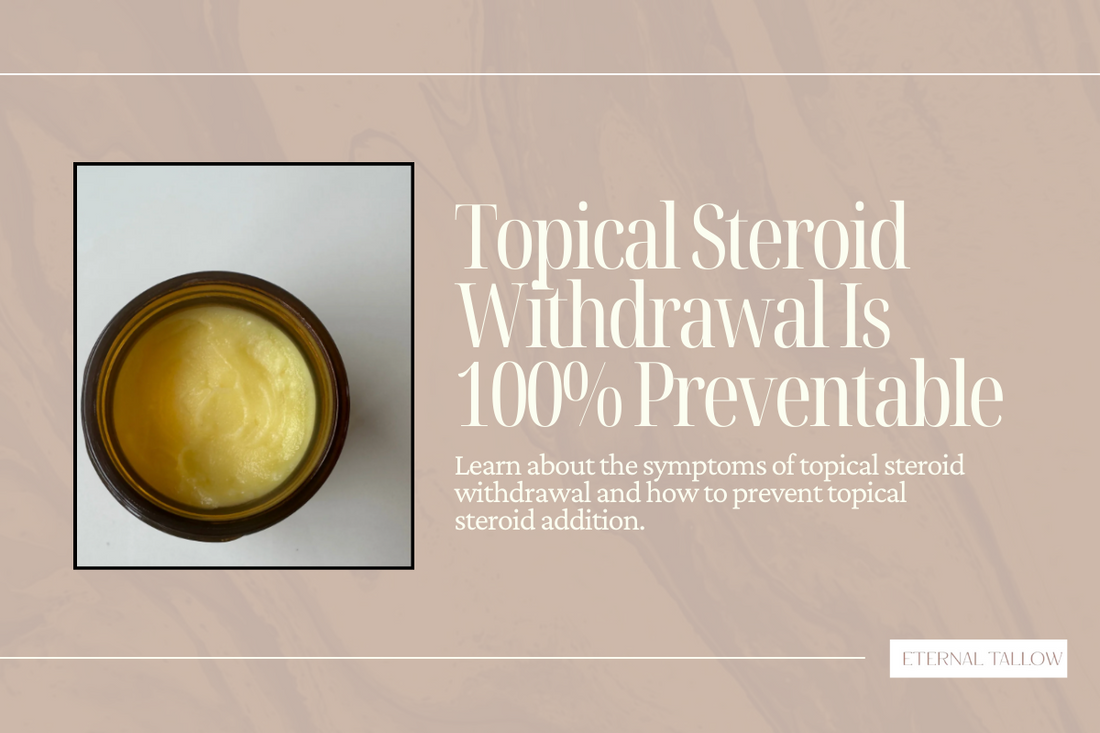 Topical steroid withdrawal is 100% preventable