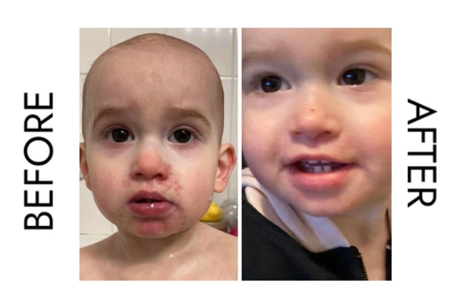Before and after pictures of tallow lotion clearing up skin on baby