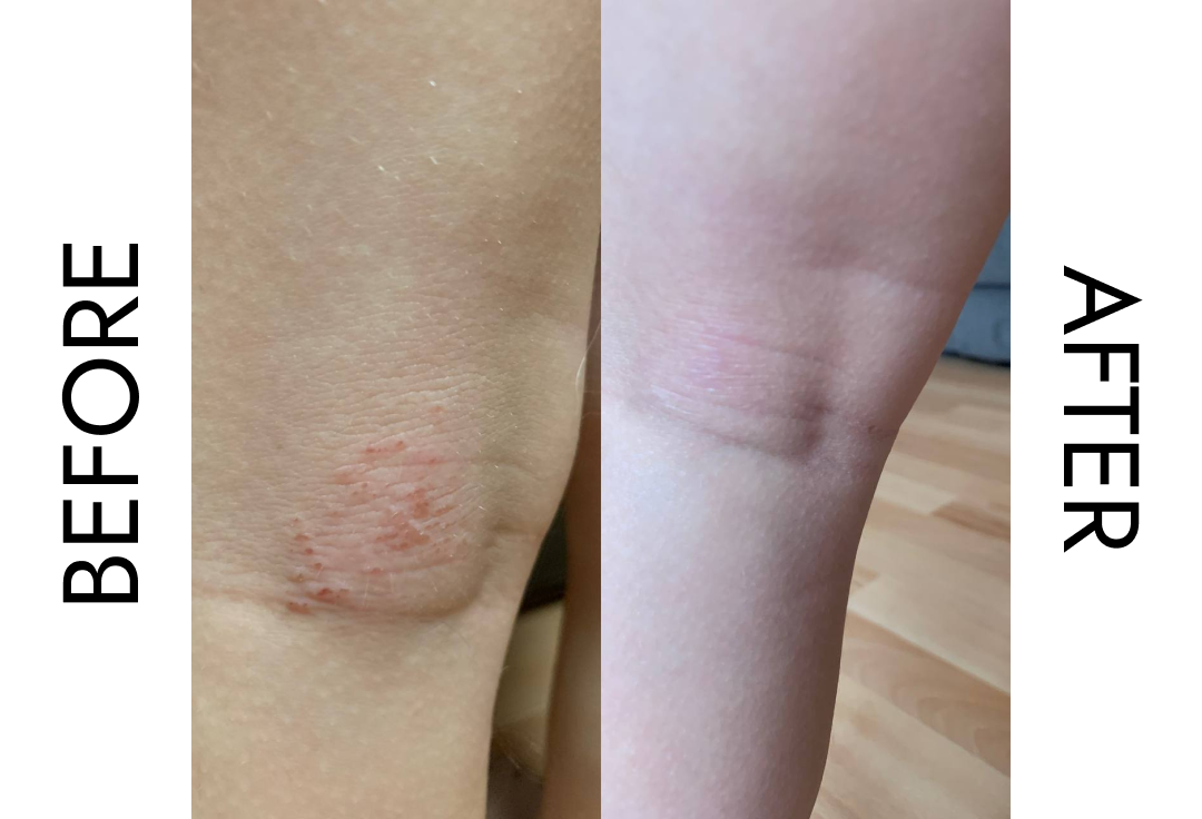 Tallow Skin Before After Pictures Eternal Tallow tallow-skin-before-after-pictures-eternal-tallow